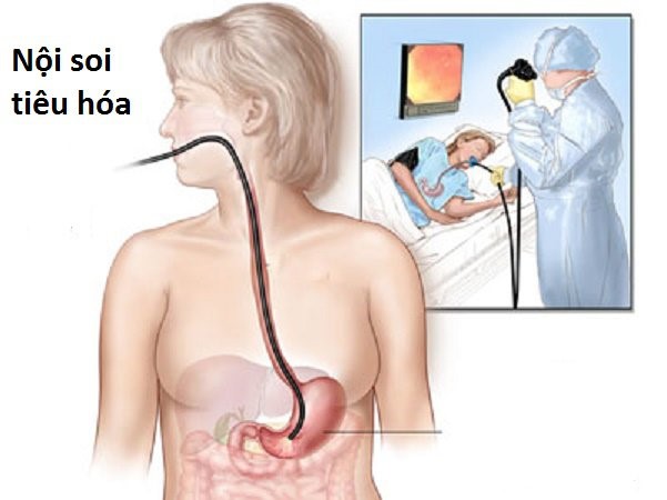 Nội soi tiêu hóa